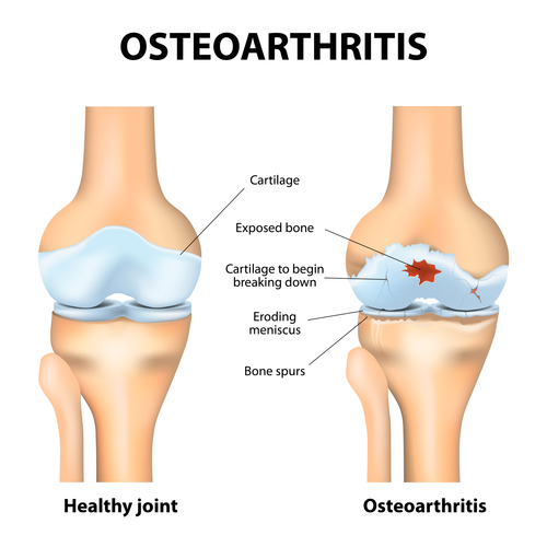 Knee Osteoarthritis