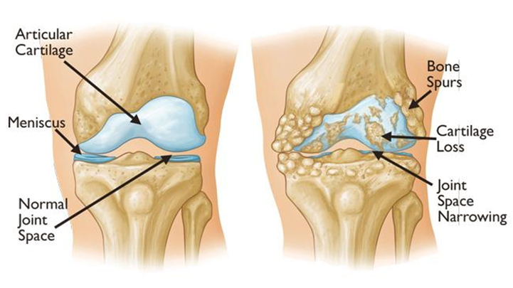 Knee Pain Specialist in Odisha