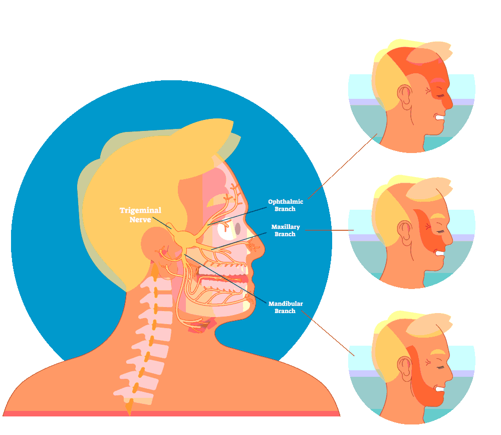 Trigeminal Neuralgia No More Empowering Stories of Recovery at Neuron