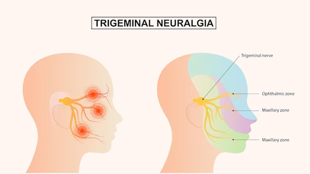 Trigeminal-Neuralgia1