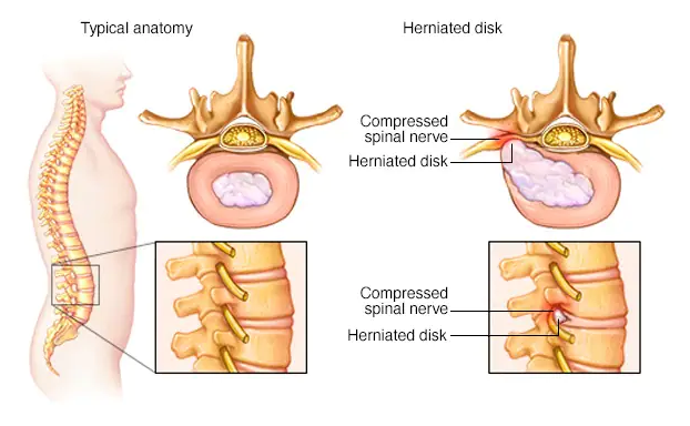 Lumbar Disc Herniation or Slipped disc